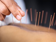 Get Acupuncture treatment Nearby Your Location