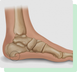 Flat Foot Treatment Perth Amboy, NJ