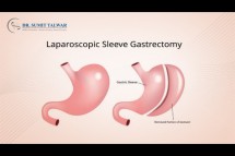 Best Laparoscopic Sleeve Gastrectomy Treatment in Bangalore