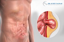 Best Doctor for Complex Abdominal Hernia Surgery in Bangalore