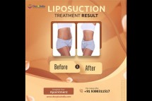 Expert Liposuction Surgery in Hyderabad at Docplus India