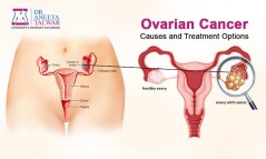 Cost of Ovarian Cancer in Manipal