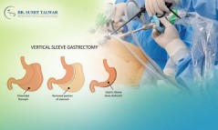 Best Advanced Bariatric Surgeon in Bangalore - Dr. Sumit Talwar