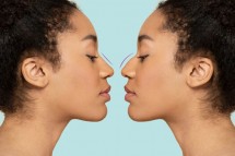 Rhinoplasty Swelling Stages | Expectation After Rhinoplasty