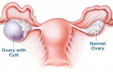 Laparoscopic Ovarian Cystectomy in Dubai