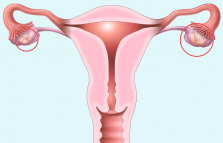 Endometrial Cancer Treatment in Dubai