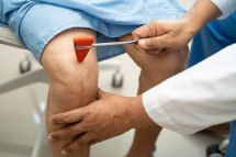 Expert ACL Injury Treatment by Leading Knee Surgeon in Manchester