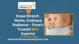 Stretch Mark Removal In Pune | Stretch Mark Treatment