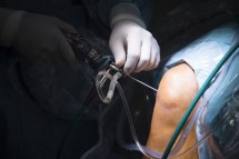 Manchester Cartilage Regeneration Surgery: Restore Knee Health